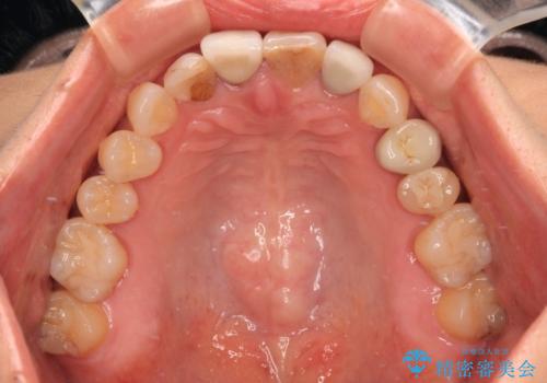 モザイク模様の前歯 オールセラミッククラウンで整った印象にの治療前