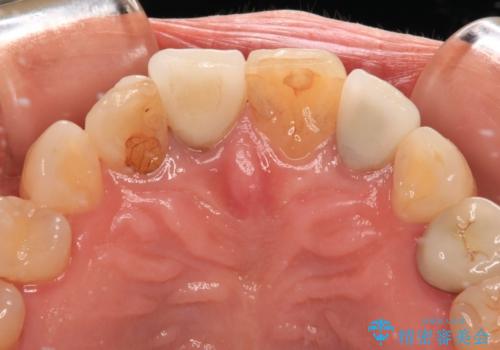 モザイク模様の前歯 オールセラミッククラウンで整った印象にの治療前