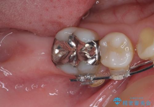 出っ歯と奥歯の欠損 ワイヤー矯正とインプラント治療の治療前