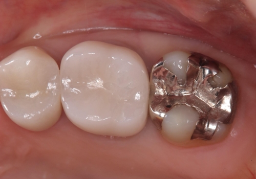 二次う蝕が心配の治療前