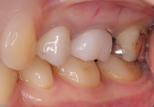 二次う蝕が心配の治療前