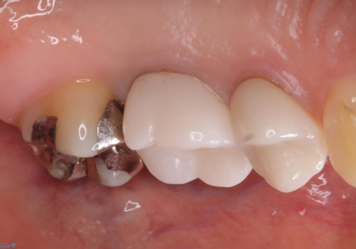 二次う蝕が心配の治療前