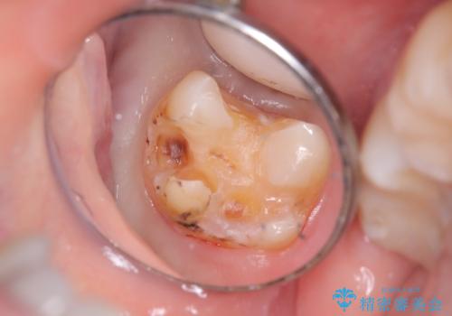 二次う蝕が心配の治療中