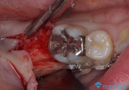 出っ歯と奥歯の欠損 ワイヤー矯正とインプラント治療の治療中
