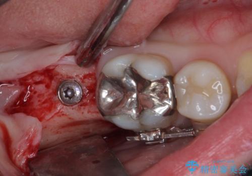 出っ歯と奥歯の欠損　ワイヤー矯正とインプラント治療の治療後