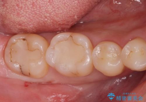 古い樹脂の劣化 セラミックインレー治療の症例 治療前