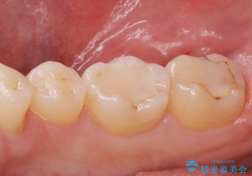 古い樹脂の劣化 セラミックインレー治療の治療前