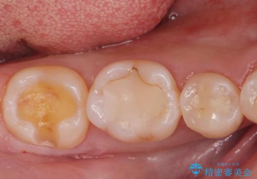 古い樹脂の劣化 セラミックインレー治療の治療中