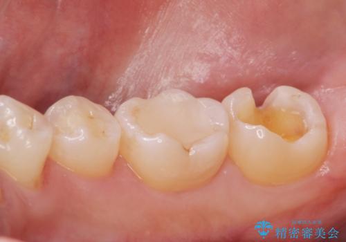 古い樹脂の劣化 セラミックインレー治療の治療中