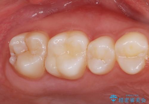 歯と歯の間の虫歯 e-maxインレーで修復の症例 治療前