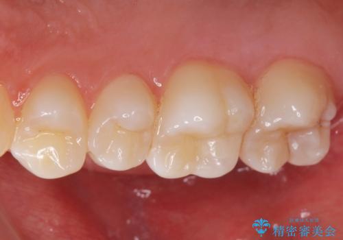 歯と歯の間の虫歯 e-maxインレーで修復の治療前