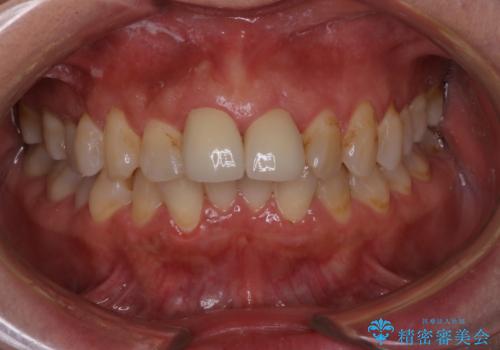 詰め物が突然とれたの症例 治療後