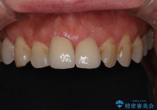 詰め物が突然とれたの治療後