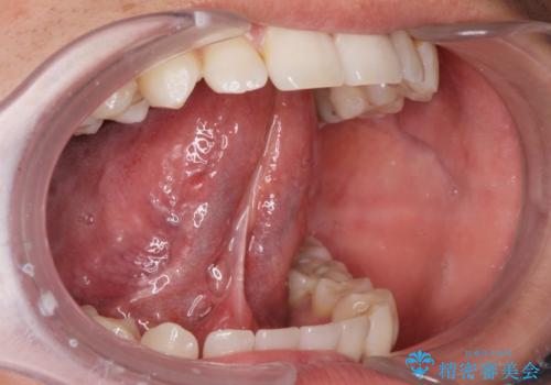 ラ行が言いにくい。の治療前
