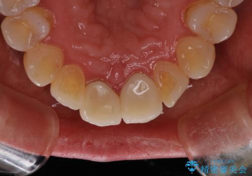 詰め物が突然とれたの治療後