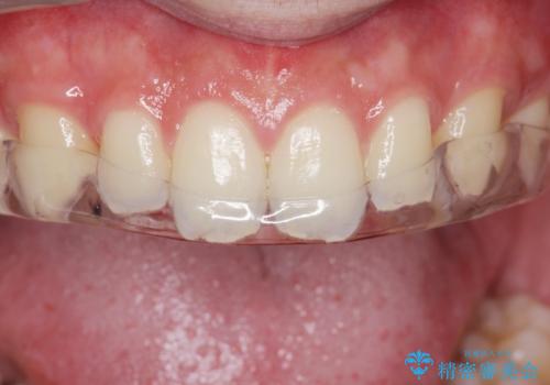 ナイトガードで歯の予防をしたい。の治療後
