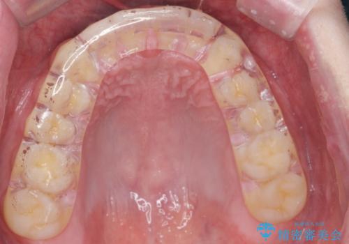 ナイトガードで歯の予防をしたい。の治療後
