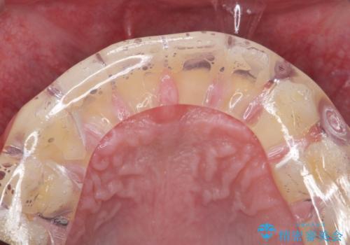 ナイトガードで歯の予防をしたい。の治療後