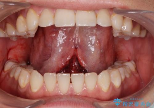 ラ行が言いにくい。の治療中