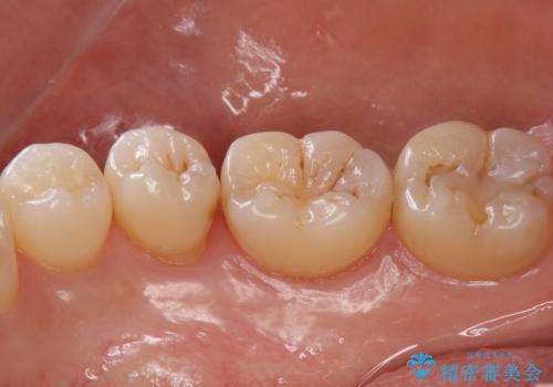 歯と歯の間の虫歯 セラミックインレーでの修復処置の治療前