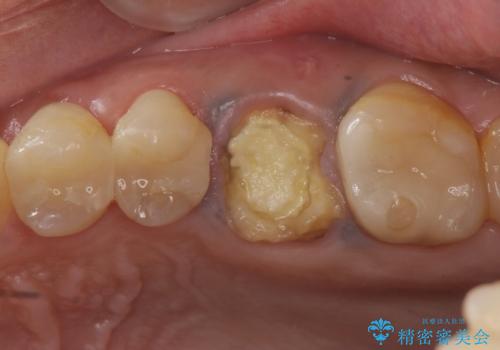 予後の悪い歯を抜歯　インプラントでの治療の症例 治療前