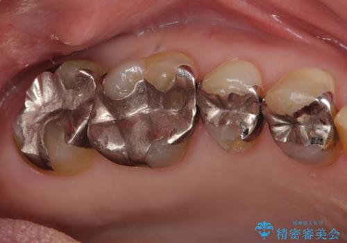 歯が欠けた 金属による割れない修復の治療前