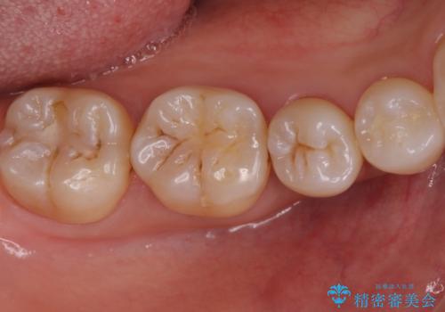 歯と歯の間の虫歯　セラミックインレーでの修復処置の治療前