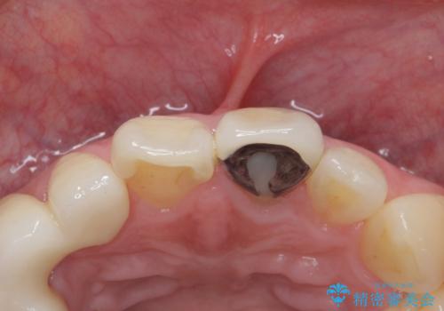 前歯を綺麗にしたい ジルコニアクラウンでの治療の治療前