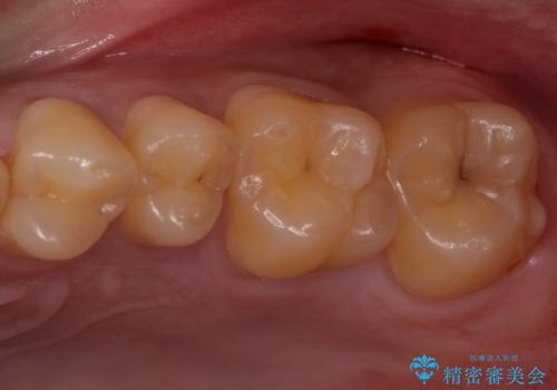 奥歯の虫歯　セラミックインレーでの修復処置の治療前