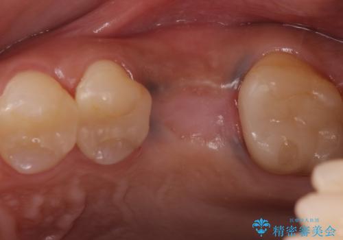 予後の悪い歯を抜歯　インプラントでの治療の治療後