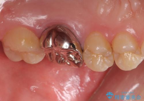 不適合な被せ物 ジルコニアクラウンでの再治療の治療前