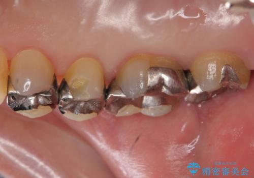 歯が欠けた 金属による割れない修復の治療前