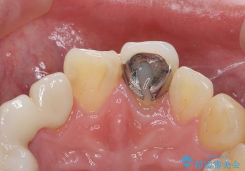 前歯を綺麗にしたい ジルコニアクラウンでの治療の治療前