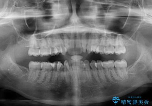 前歯のガタガタを整えたい ワイヤー装置による抜歯矯正治療の治療前
