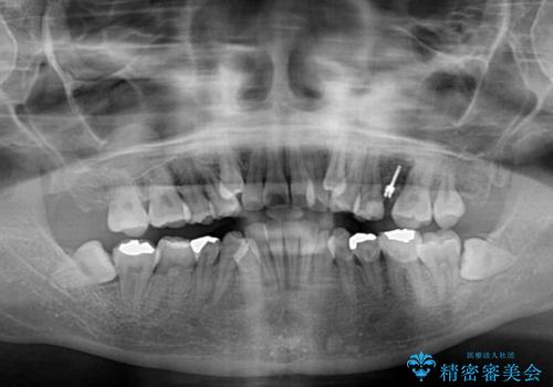【モニター】上下の八重歯を治したい　ワイヤー装置による矯正治療の治療前