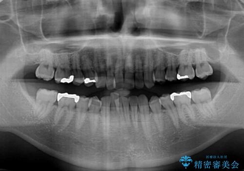 深い咬み合わせで顎が疲れる ワイヤー矯正でディープバイトを解消の治療前