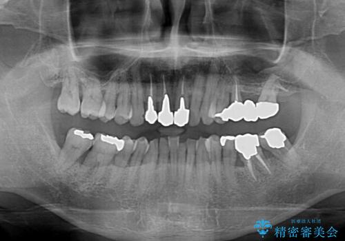 変色した前歯をきれいにしたい 部分矯正を併用した前歯の審美歯科治療の治療前
