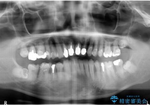 インプラント・ブリッジ補綴を含む、歯周病全顎治療の治療前