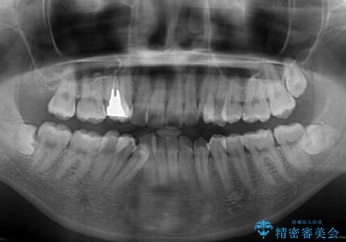 デコボコで磨きにくい歯列 ワイヤー装置での抜歯矯正で歯磨きをしやすくの治療前