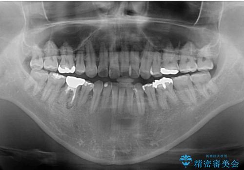 【モニター】舌のトレーニングを行いながら後戻りの再矯正の治療前