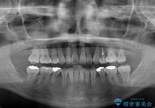 【モニター】上下の八重歯を治したい　ワイヤー装置による矯正治療の治療後