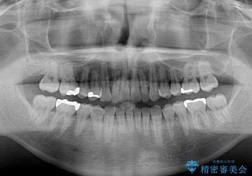 深い咬み合わせで顎が疲れる ワイヤー矯正でディープバイトを解消の治療後