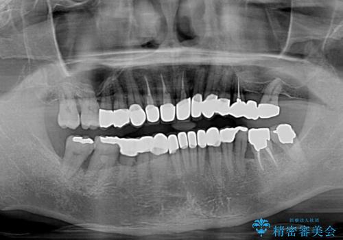 変色した前歯をきれいにしたい　部分矯正を併用した前歯の審美歯科治療の治療後