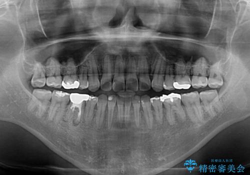 【モニター】舌のトレーニングを行いながら後戻りの再矯正の治療後