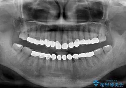 前歯の変色と隙間を治したい 前歯の審美歯科治療の治療後