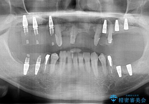インプラント・ブリッジ補綴を含む、歯周病全顎治療の治療中