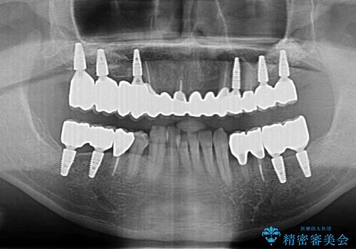 インプラント・ブリッジ補綴を含む、歯周病全顎治療の治療後