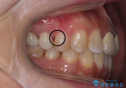 【セラミックインレー】フロスを通すと血が出て臭うの治療前