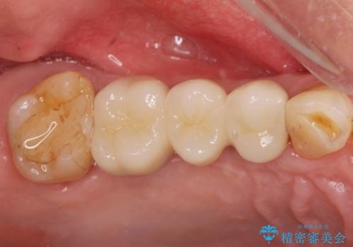 失った奥歯を、インプラント治療で機能回復の治療後