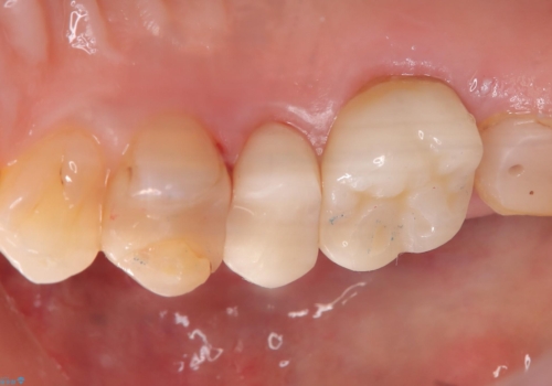 【セラミックインレー】フロスを通すと血が出て臭うの治療前